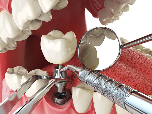Best Emergency Dental Care for Broken or Chipped Teeth in Welch, WV